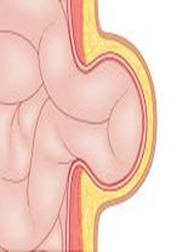 DEFINICIÓN DE<br>PROTRUSIÓN